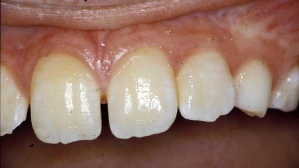 Diese Abbildung zeigt eine deutliche Fluorose beim Kind